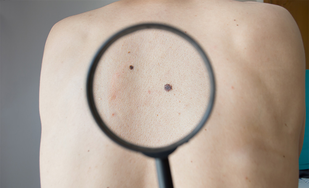 Forskarnas besked: appar identifierar inte hudcancer